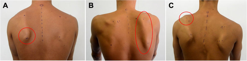 肩膀痠痛｜肩胛的重要性超乎想像—你的肩膀也不對稱嗎？｜晉熯脊骨物理治療所