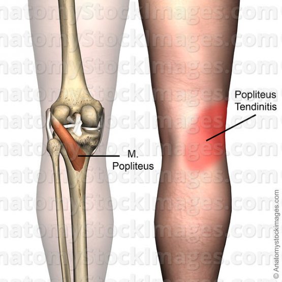 膝關節扭傷｜膝關節的關鍵點–膕肌(popliteus)｜晉熯脊骨物理治療所