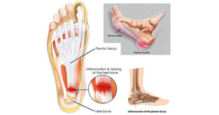 足底筋膜炎｜一條足底筋膜不夠用？那你有多用幾條嗎？｜晉熯脊骨物理治療所