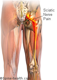 坐骨神經痛｜腰痛好了，怎麼換膝蓋痛?｜晉熯脊骨物理治療所