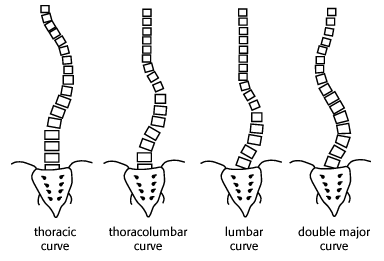 衛教資訊｜脊椎側彎不只要矯正「側彎」｜晉熯脊骨物理治療所