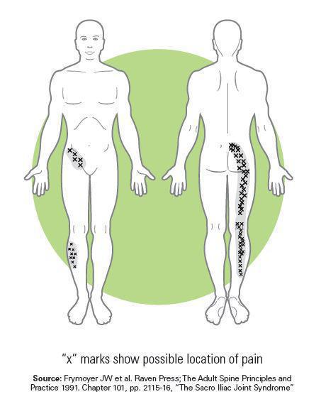 椎間盤突出｜造成腰痛的另一個藏鏡人–「薦髂關節」｜晉熯脊骨物理治療所