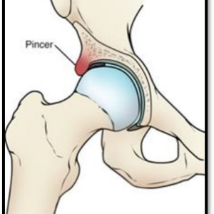 台北物理治療｜鉗夾型(Pincer type)髖臼過度覆蓋股骨頭｜晉熯脊骨物理治療所